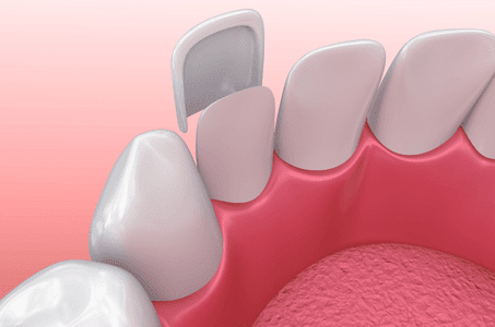 Dental Veneers Dental Veneers