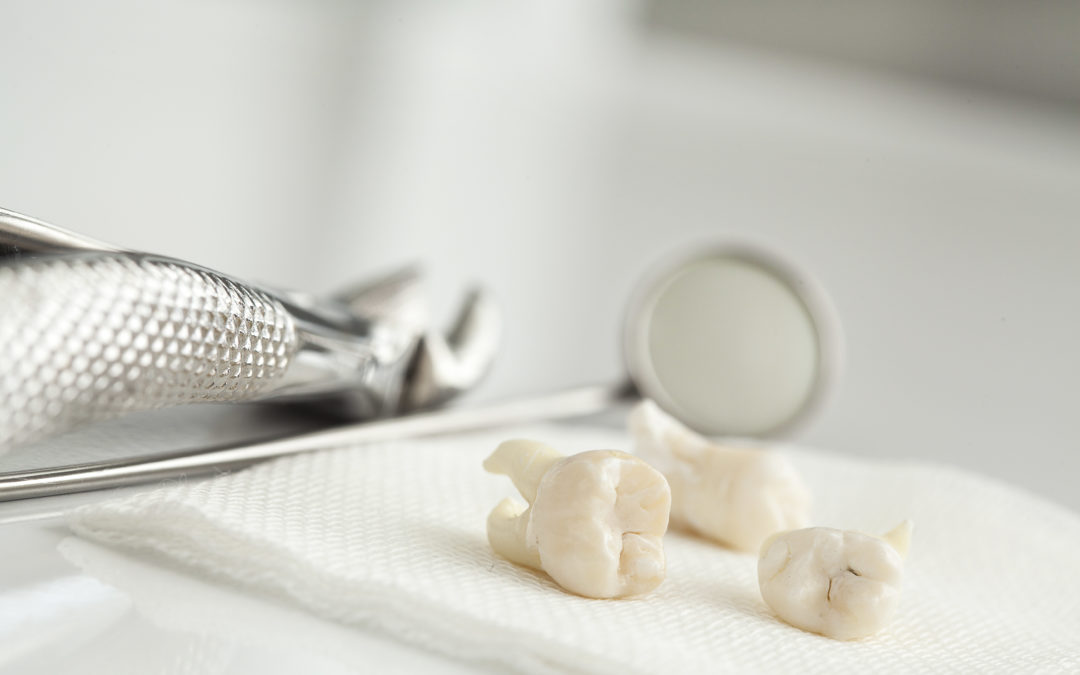 Wisdom Teeth Removal: Is It Really That Necessary?