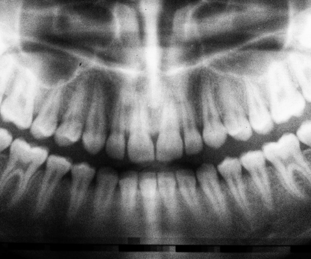 xray teeth close up mill dam dental virginia beach