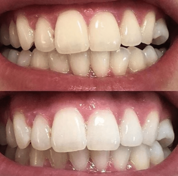 before and after teeth cleaning