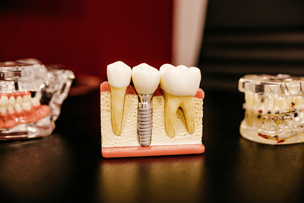 Dental Implant or Root Canal