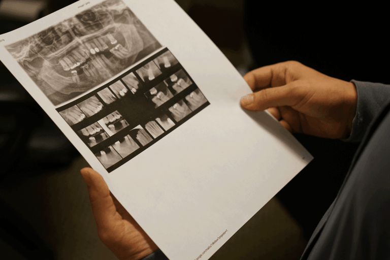 Dental Crowns or Implant