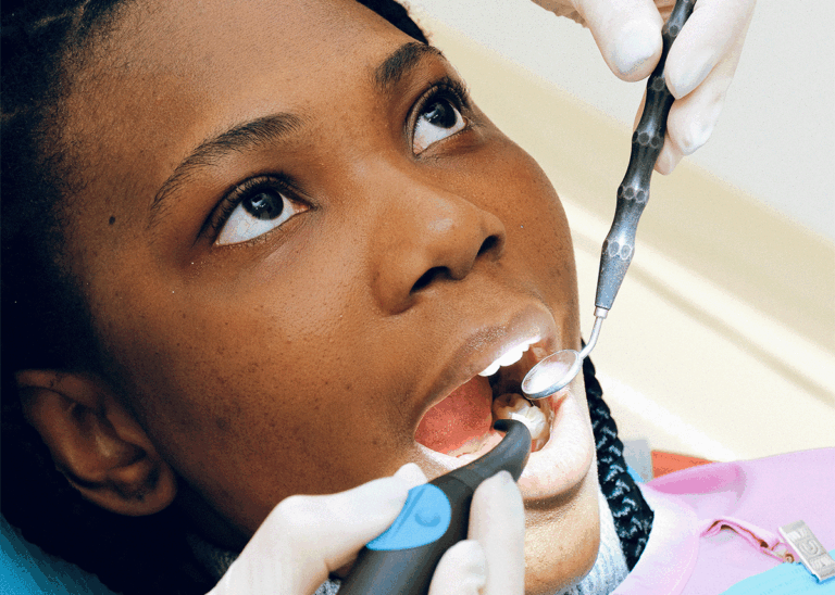 How Long Do Fillings Last?