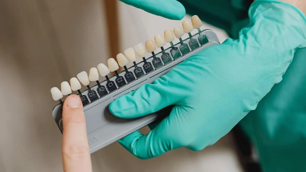 At-Home Whitening Treatments