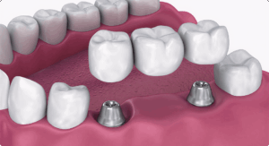 dental bridge